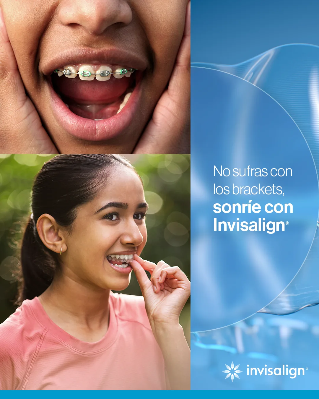Invisalign Teen: adolescente sonriendo con sus alineadores — sin brackets, sonríe con Invisalign